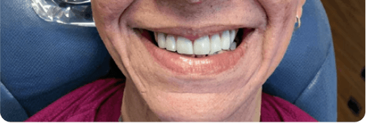 Smile Transformation 1 after