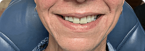 Smile Transformation 1 before
