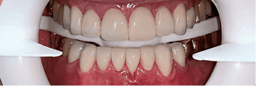 Smile Transformation 2 after