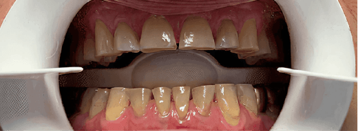 Smile Transformation 2 before
