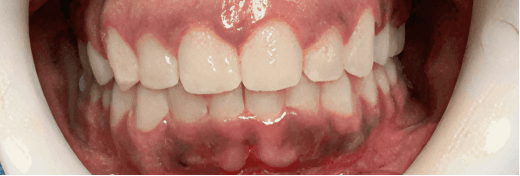Smile Transformation 3 after