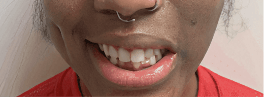Smile Transformation 3 before