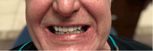 Smile Transformation 4 after