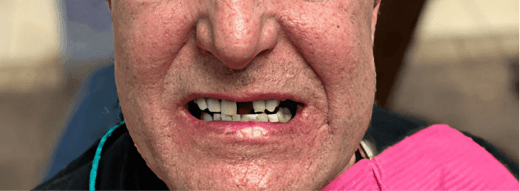 Smile Transformation 4 before