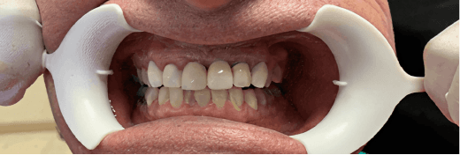 Smile Transformation 5 after