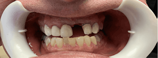 Smile Transformation 5 before