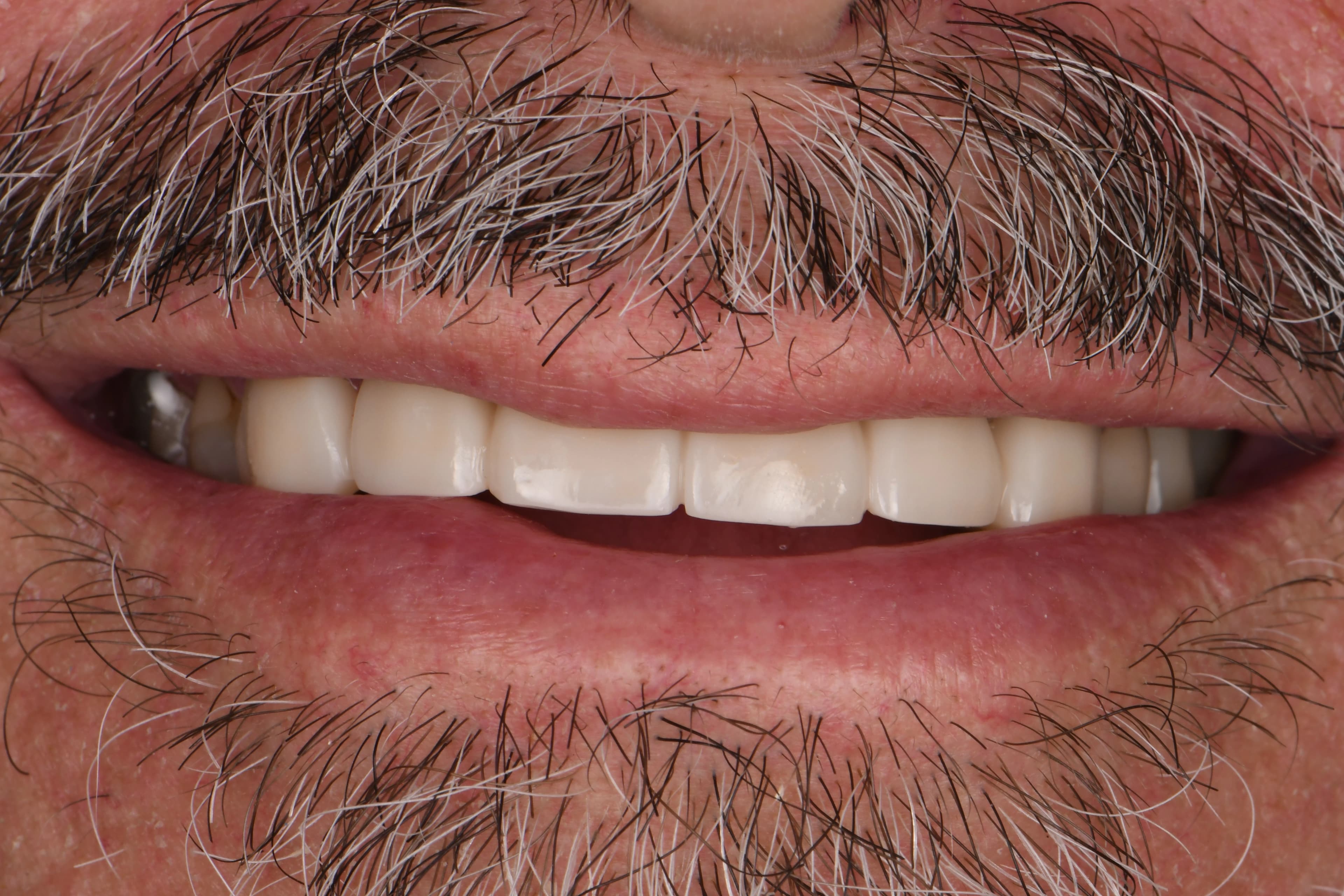 Smile Transformation 6 after