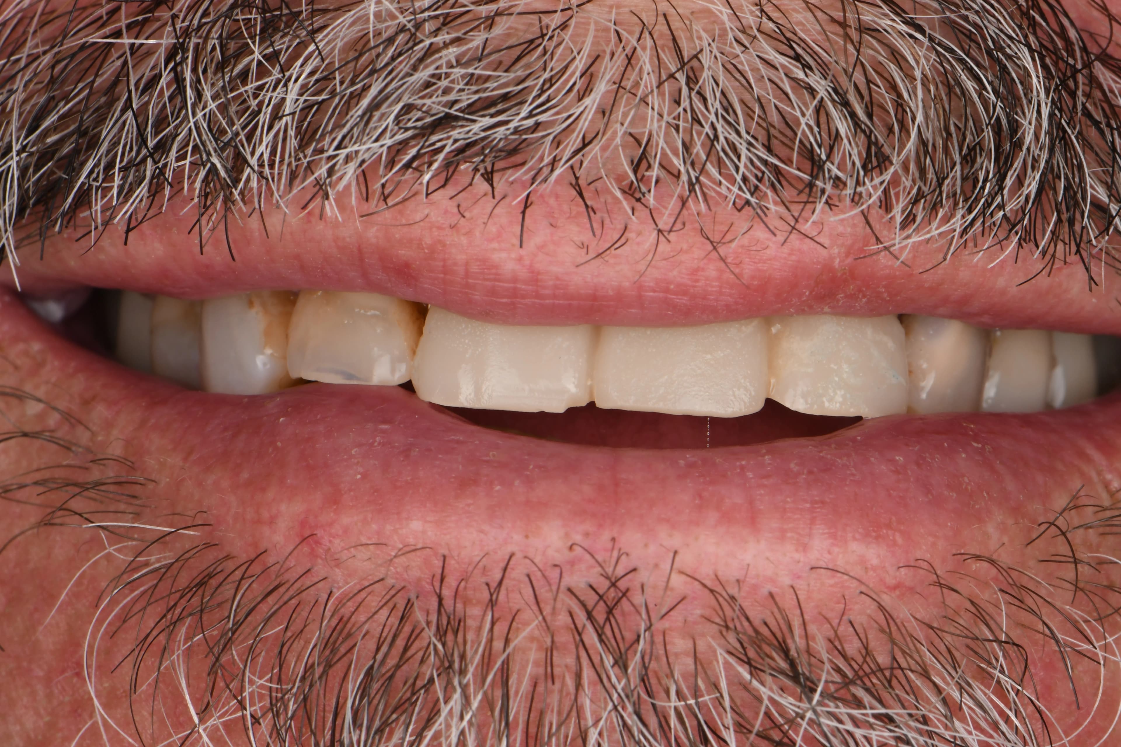 Smile Transformation 6 before